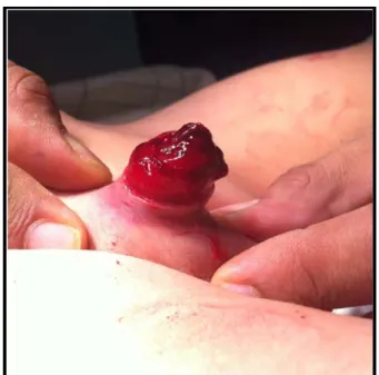 Figure 9 : Amputation totale du gland admis à H2 : 