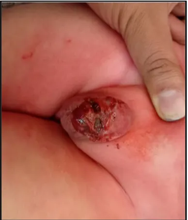 Figure 14 : infection avec nécrose cutanée 