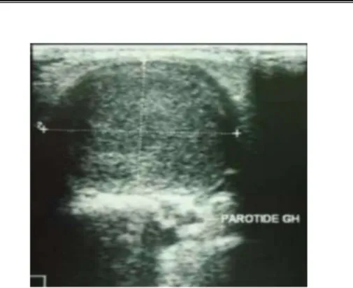 Figure 5 : Echographie de la région parotidienne gauche montrant une masse tissulaire  hétérogène du pole inferieur de la glande parotide gauche 