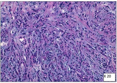 Figure 21 : Carcinome mammaire infiltrant de type spécifique Lobulaire (coloration HE) service  d’anatomie pathologique, CHU Mohammed VI Marrakech 