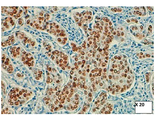 Figure 30: Carcinome mammaire infiltrant avec récepteurs de l'Estrogène Positifs (expression  nucléaire intense de plus de 90% des cellules tumorales exprimant l’anticorps anti-Estrogène) service 
