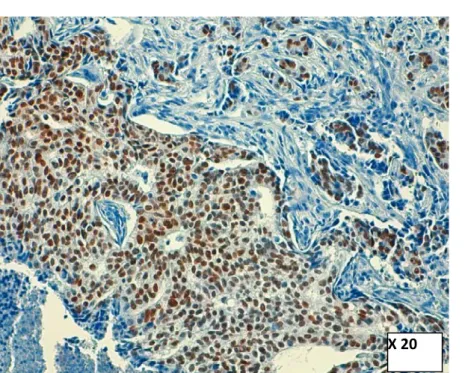 Figure 34 : Carcinome mammaire infiltrant avec récepteurs de la Progestérone Positifs (expression  nucléaire intense de plus de 90% des cellules tumorales exprimant l’anticorps anti- Progestérone) 