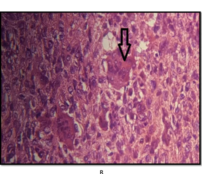 Figure 12 B :Aspect microscopique  A(HEx25)B   ( HE x40): cellules géantes munies de  noyaux à disposition centrale au sein d’un cytoplasme abondant