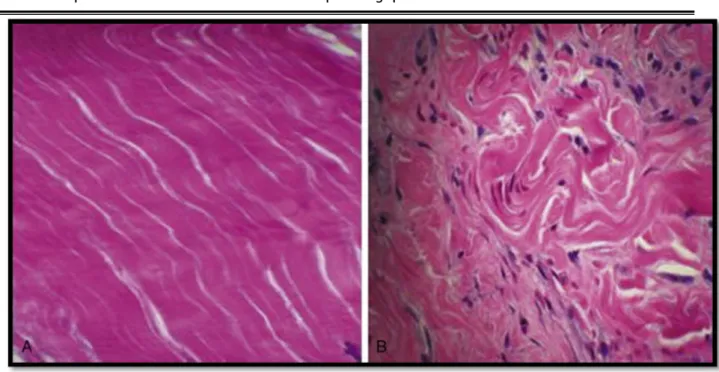 Figure 16 : Image histologique du tendon normal et pathologique : A : Un tendon normal et  sain avec un alignement parallèle des fibres de collagène