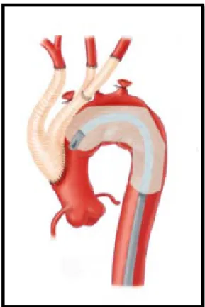 Figure 21 : Schéma représentant la transposition totale des troncs supra-aortiques.    Le bilan biologique préopératoire (NFS, groupage, ionogramme, TP, TCA) était sans  anomalies