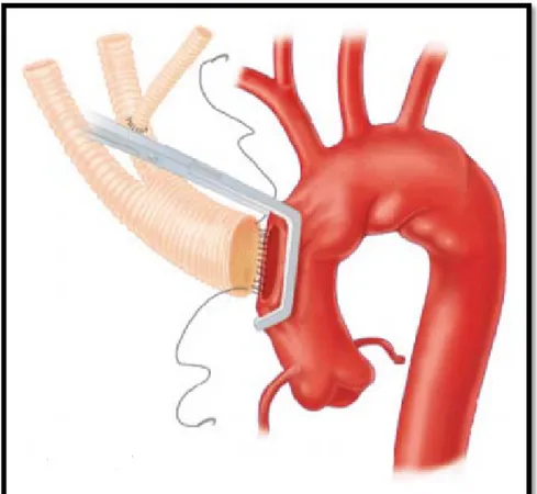 Figure 22 : Schéma montrant le clampage de l’aorte ascendante et l’anastomose avec une  prothèse trifurquée