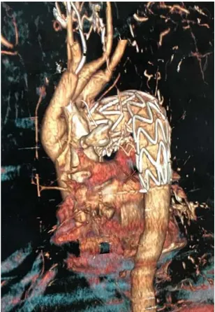 Figure 24 : Artériographie montrant l’endoprothèse et la perméabilité des trocs supra-aortiques  (image du Pr.M.Alaoui).
