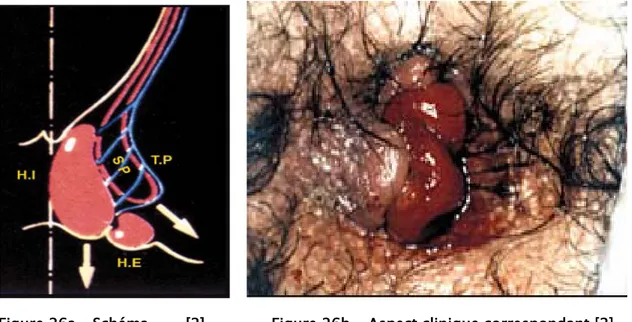 Figure 26 –  Hémi-coupe frontale du canal anal : aspect anatomique hémorroïdes stade 3,  prolabées à l’effort mais réductibles seulement au doigt 