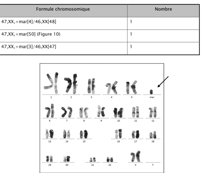 Tableau III : Les différentes variantes cytogénétiques des marqueurs chromosomiques surnuméraires  chez nos patients 