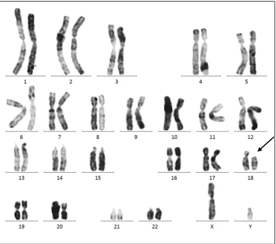 Figure 17 : Délétion du bras court d’un chromosome 18 : Monosomie 18p chez un patient  46,XY,del(18)(q11.1) 
