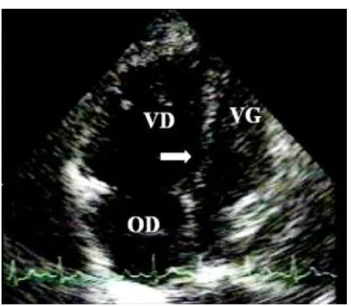 Figure 13: Dilatation ventriculaire droite majeure au cours d’une embolie pulmonaire 