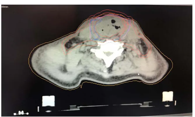 Figure 11 : Coupe axiale montrant les volumes cibles tumoraux et ganglionnaires 