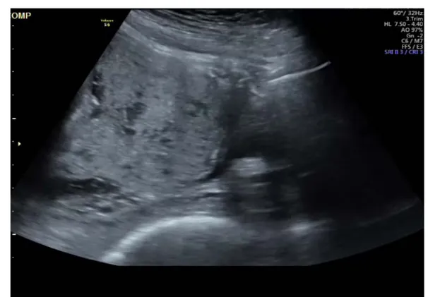 Figure 7 : Diagnostic anténatal de placenta accreta (lacunes placentaires). 