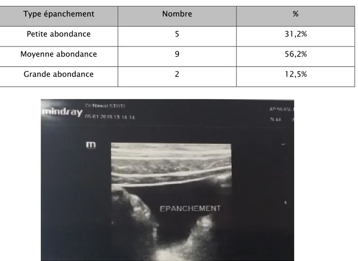 Tableau IV : le nombre et le type d’épanchement retrouvé à l’échographie abdominale 