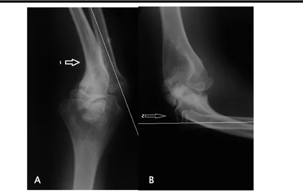 Figure 9 : Radiographie du coude de face (A) et profil (B) d’une lésion de Monteggia type II de  Bado chez un enfant de 8ans sexe masculin montrant une fracture plastique de la métaphyse 