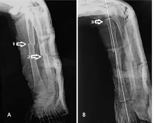 Figure 11 : Radiographie de l’avant-bras de face (A) et profil (B) d’une lésion de Monteggia type  IV de Bado chez un enfant sexe masculin âgé de 12 ans montrant une fracture déplacée au  niveau du tiers moyen des 2 os de l’avant-bras (flèches 1, 2)  avec une luxation antérieure de la 