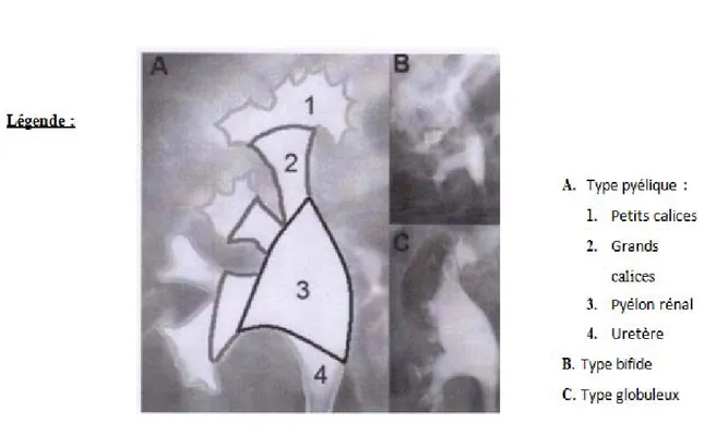 Figure 5 : Variations morphologiques du système collecteur rénal sur des clichés d’UIV de face