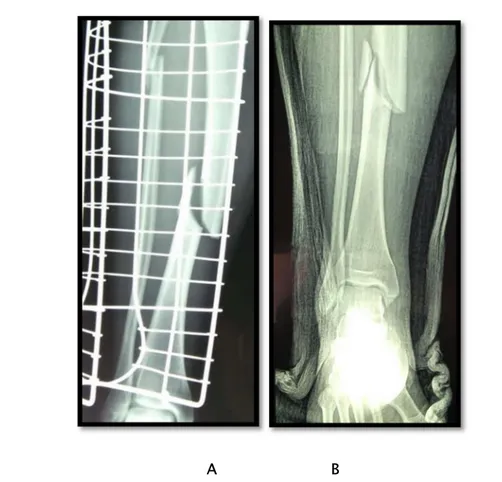 Figure 11 : Radiographie de face de la jambe montrant une fracture des 2 os de la jambe avec  fracture  du 1/3 moyen de la diaphyse tibiale et du col du peroné (A) et une fracture du 1/3 