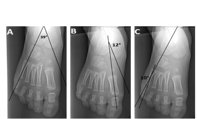 Figure 8 : Radiographies pré opératoires face d’un enfant de 5 ans (Cas numéro 4) ,ayant un  pied plat idiopathique qui montrent la perturbation des angles