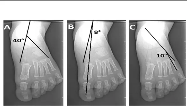 Figure 10 : Radiographies pré opératoires face  d’un enfant de 5 ans ( Cas numéro 12) ayant un  pied plat idiopathique qui montrent la perturbation des angles
