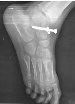 Figure  22 : Radiographie du pied montrant une extériorisation de la vis chez le cas numéro 13