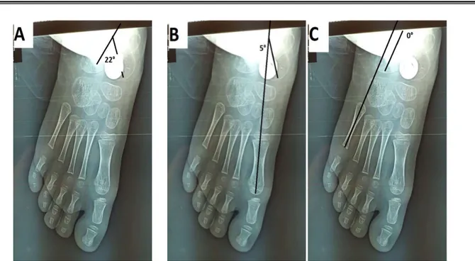 Figure 32: Radiographies du pied  face  montrant l’amélioration des angles post opératoires (à J3  post opératoire du cas numéro 4