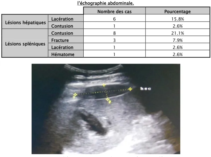 Tableau XIII : Les différentes lésions viscérales au cours des traumatismes abdominaux à  l’échographie abdominale
