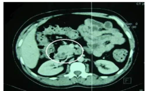 Figure 9 : processus lésionnel tumoral céphalique du pancréas, importante dilatation des VBIH  etVBP ainsi que la distension vésiculaire