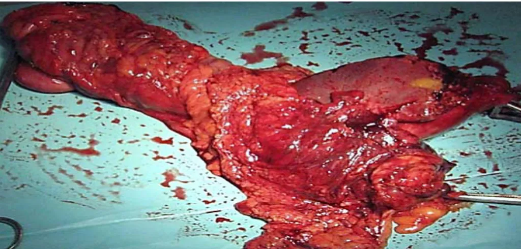 Figure 13: Pièce opératoire de la bisegmentectomie IV et V, la cholécystectomie, le curage  ganglionnaire et l'hémi colectomie droite