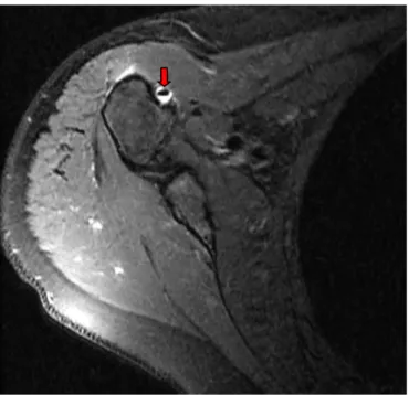 Figure 20 : Epanchement en hypersignal au niveau de la gaine bicipitale (flèche rouge)   (Coupe axiale en DP FAT SAT)  