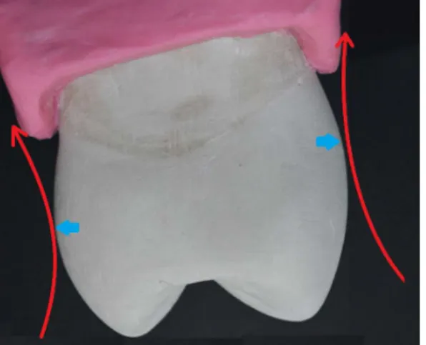 Figure 1 : vue mésiale de la 24 :   Des bombés bien situés et d’un volume correct 
