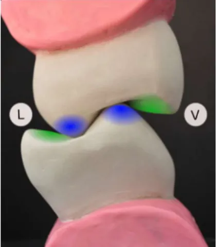 Figure 10 : vue distale d’un  secteur molaire droit : cuspides  d'appui (bleues) et cuspides guide 