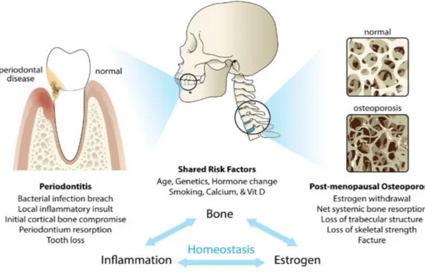 Figure 7: Lien maladie parodontale/ostéoporose (54)