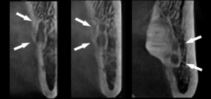 Figure  16.  Image  d’un  examen  Cone-Beam  CT  d’une  mandibule,  côté  droit  (patient  masculin,  54  ans)