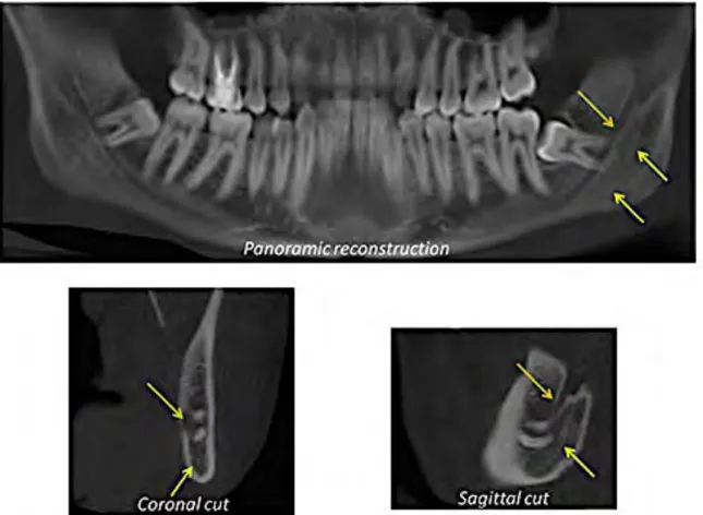 Figure  18.  Reconstitution  panoramique,  coupe  coronale  et  sagittale  issus  d’un  volume  CBCT réalisé sur le même patient que la figure 21