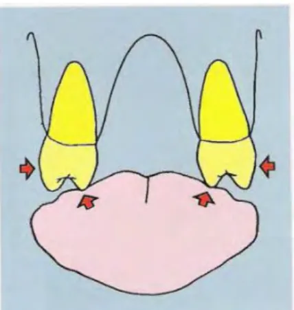 Figure 8 : macroglossie, avec empreintes des dents sur les bords latéraux de la langue 