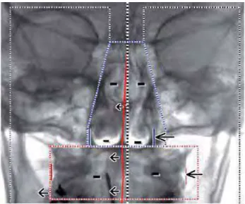 Figure 16 : Analyse architecturale de face : asymétrie et rétrécissement des fosses nasales, endognathie maxillaire, décalage vers la  droite des points médians                                                            