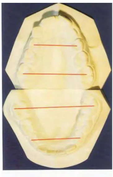 Figure 19 : examen de la symétrie du maxillaire : dans Le plan sagittal et  transversal  Figure 18 : mesure du périmètre de l’arcade 