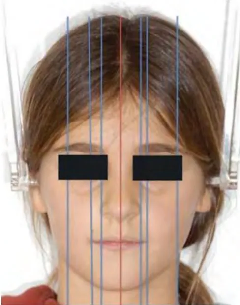 Figure 20 : photo de face : symétrie du visage et largeur de la bouche selon nanda (7) 