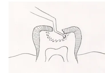 Figure  7 : élimination des ponts d'émail non soutenus à l'aide d'un ''dental  hatchet''