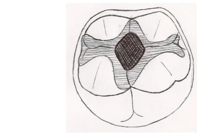 Figure 8 : restauration (ART) d'une cavité de classe I et scellement des sillons  adjacents