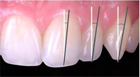 Figure	  8	  :	  Axe	  des	  dents	  par	  rapport	  à	  la	  verticale.	   	  