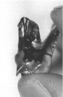 Figure 7 : Prémolaire diaphanisée et inclue  dans la résine, par Yamamoto 