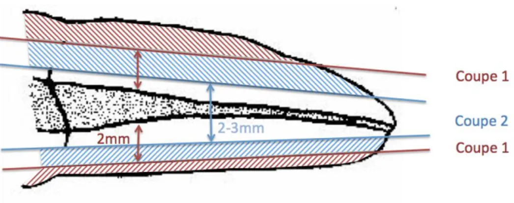 Figure 8 : Schéma illustrant les deux étapes de coupes de Malentacca 