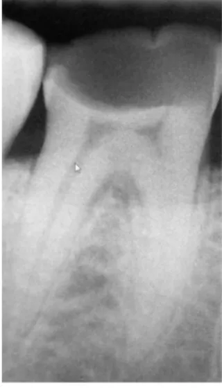 Figure 11 : Radiographie de  molaire avec exposition pulpaire  distale 