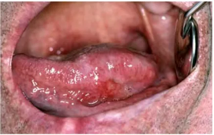 Figure 13. Carcinome épidermoïde(25)