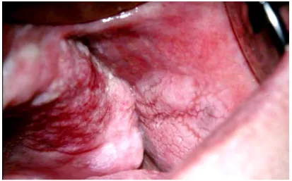 Figure 14. Carcinome verruqueux (25)