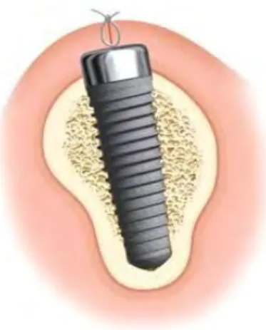 Figure 17. Implant enfoui (70) 
