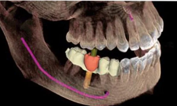 Figure 12 :   Implant angulé selon le projet prothétique et le trajet du nerf mandibulaire (Dentsply Sirona) 