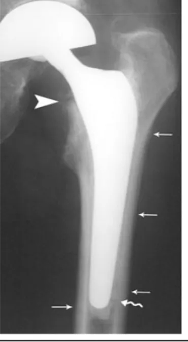 Figure 1 : Sepsis, appositions périostées  de type subaiguë (petite flèche)  associées à une résorption floue de la  tête du Merkel (tête de flèche) et à un  descellement avec migration caudale de 